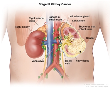 Stage III kidney cancer; drawing shows cancer in the left kidney and in a) nearby lymph nodes, b) the renal vein, c) the structures in the kidney that collect urine, and d) the layer of fatty tissue around the kidney. Also shown are the right kidney, vena cava, and right and left adrenal glands.