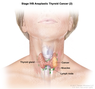 Stage IVB anaplastic thyroid cancer (2); drawing shows cancer in the thyroid gland and nearby muscles in the neck. The lymph nodes are also shown.
