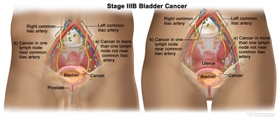 Two-panel drawing showing stage IIIB bladder cancer in a male (left panel) and a female (right panel); both panels show cancer in the bladder and in (a) more than one lymph node in the pelvis that is not near the common iliac artery and (b) one lymph node near the common iliac artery. Also shown are the right and left common iliac arteries, the prostate (left panel), and the uterus (the right panel).