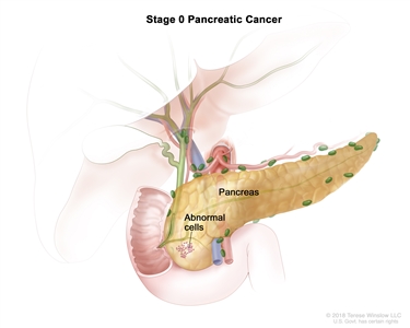 Stage 0 pancreatic cancer; drawing shows abnormal cells in the pancreas.