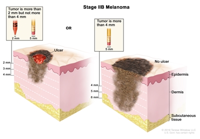 Melanoma Treatment (PDQ®): Treatment - Patient Information [NCI] | Cigna