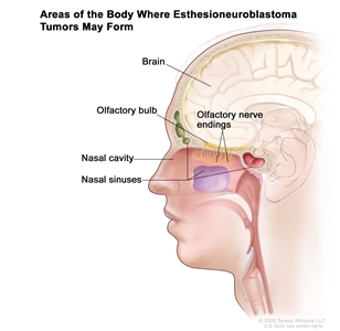 Drawing shows areas of the body where esthesioneuroblastoma tumors may form, including the olfactory nerve endings, olfactory bulb, nasal cavity, nasal sinuses, and brain.