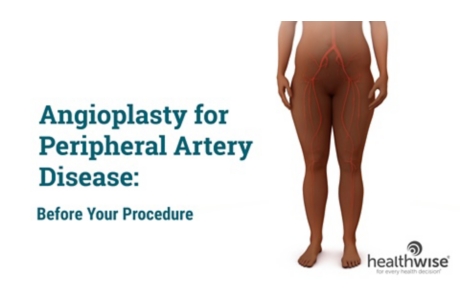 Angioplasty for Peripheral Artery Disease: Before Your Procedure