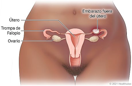 Órganos reproductores femeninos en la pelvis, que incluyen el útero, los ovarios y las trompas de Falopio, donde se muestra un embarazo fuera del útero en la trompa de Falopio.