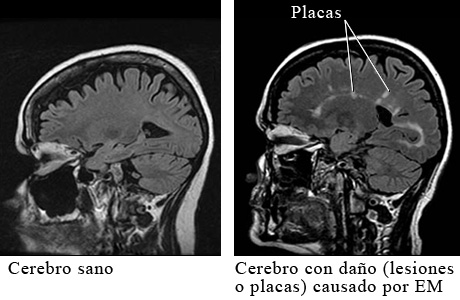 MRI de esclerosis múltiple