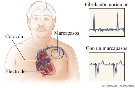 Ubicación del marcapasos en el pecho, con detalle de los resultados de los electrocardiogramas antes y después de su colocación