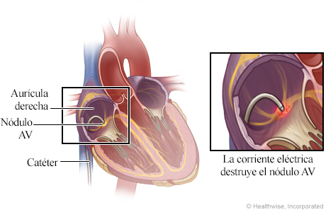 Ubicación del catéter en el corazón, con detalle de la corriente eléctrica destruyendo el nódulo AV