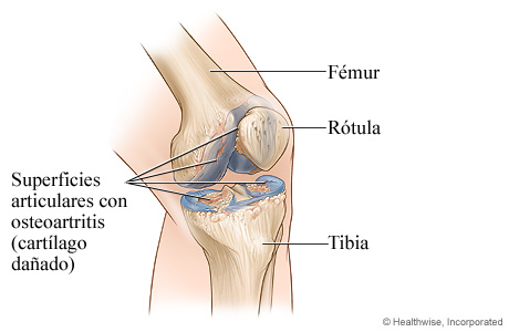 Articulación de la rodilla con osteoartritis