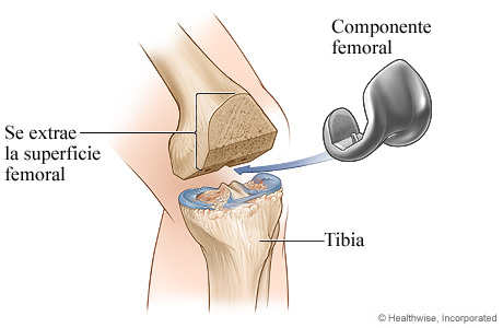 Artroplastia de rodilla: Componente femoral