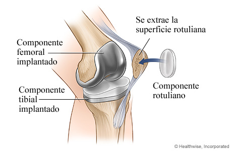 Artroplastia de rodilla: Componente rotuliano