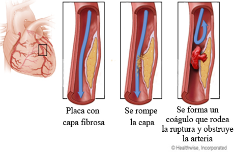 Ruptura de placa y formación de un coágulo en una arteria coronaria