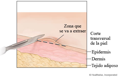 Biopsia de la piel por rasurado