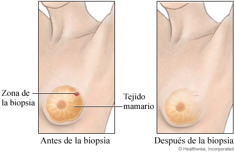 Biopsia abierta del seno (antes y después)