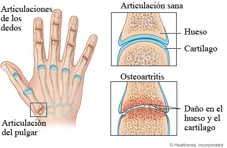 Osteoartritis de la mano