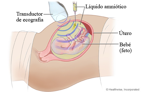 Imagen de cómo se hace una amniocentesis