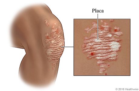 Placa de psoriasis en la rodilla
