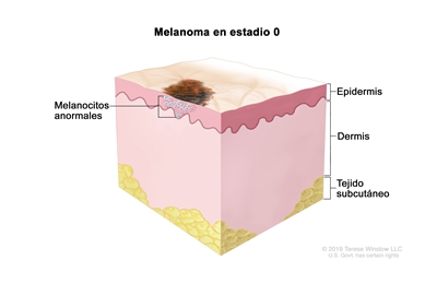 Melanoma en estadio 0. En la imagen se observa un área anormal en la superficie de la piel y melanocitos anormales en la epidermis (capa superficial o externa de la piel). También se muestra la dermis (capa profunda o interna de la piel) y el tejido subcutáneo debajo de la dermis.