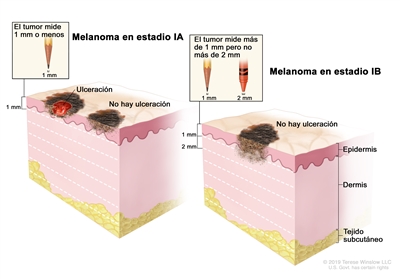 Dibujo de dos paneles del melanoma en estadio I. En el panel de la izquierda se observa un tumor en estadio IA que no mide más de 1 mm de grosor, y hay ulceración (rotura de la piel) o no hay ulceración. En el panel de la derecha se observa un tumor en estadio IB que mide más de 1 mm pero no más de 2 mm y no hay ulceración. También se muestran la epidermis (capa superficial o externa de la piel), la dermis (capa profunda o interna de la piel) y el tejido subcutáneo debajo de la dermis.