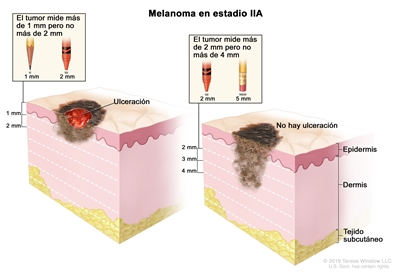 Dibujo de dos paneles del melanoma en estadio IIA. En el panel de la izquierda se observa un tumor que mide más de 1 mm pero no más de 2 mm de grosor y hay ulceración (rotura de la piel). En el panel de la derecha se observa un tumor que mide más de 2 mm pero no más de 4 mm de grosor y no hay ulceración. También se muestran la epidermis (capa superficial o externa de la piel), la dermis (capa profunda o interna de la piel) y el tejido subcutáneo debajo de la dermis.