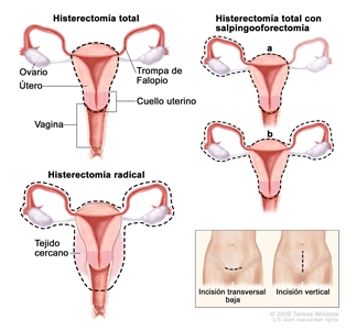Histerectomía. En la imagen se observa la anatomía del aparato reproductor femenino, que incluye los ovarios, el útero, la vagina, las trompas de Falopio y el cuello uterino. La línea de puntos indica los órganos y tejidos que se extirpan en una histerectomía total, una histerectomía total con salpingooforectomía y una histerectomía radical. En un recuadro se observa la ubicación de las dos incisiones posibles en el abdomen: una incisión transversal baja encima del área púbica y una incisión vertical entre el ombligo y el área púbica.