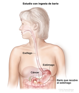Estudio con ingesta de bario para el cáncer de estómago. En la imagen se observa bario líquido que pasa por el esófago hasta el estómago.