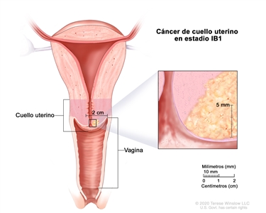 Cáncer de cuello uterino en estadio IB1. En la imagen se observa un corte transversal del cuello uterino y la vagina, y se muestra cáncer en el cuello uterino que mide menos de 2 cm. En el recuadro se muestra cáncer que se diseminó a más de 5 mm de profundidad. También se observa una regla de 2 cm, y que 10 mm equivalen a 1 cm.