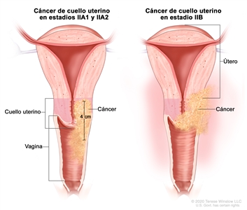 Cáncer de cuello uterino en estadio II. En la imagen se observan dos cortes transversales del útero, el cuello uterino y la vagina. En la imagen de la izquierda se muestra cáncer de cuello uterino en estadios IIA1 y IIA2, con un tumor que mide 4 cm y se diseminó a los dos tercios superiores de la vagina. En la imagen de la derecha se muestra cáncer de cuello uterino en estadio IIB que se diseminó del cuello uterino al tejido que rodea el útero.