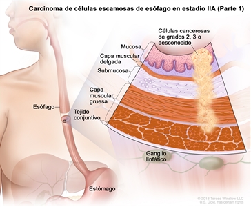 Carcinoma de células escamosas de esófago en estadio IIA (Parte 1). En la imagen se observan el esófago y el estómago. En una ampliación, se muestran células cancerosas en la mucosa, la capa muscular delgada, la submucosa y la capa muscular gruesa de la pared del esófago. Las células cancerosas son de grado 2, grado 3 o grado desconocido. También se muestran la capa de tejido conjuntivo de la pared del esófago y ganglios linfáticos.