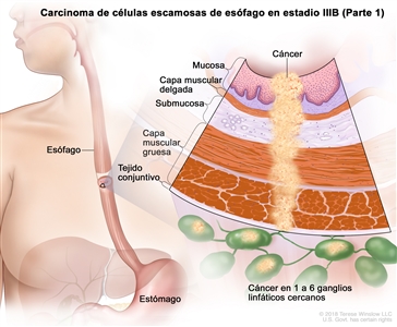 Carcinoma de células escamosas de esófago en estadio IIIB (Parte 1). En la imagen se observan el esófago y el estómago. En una ampliación, se muestra cáncer en la mucosa, la capa muscular delgada, la submucosa, la capa muscular gruesa, el tejido conjuntivo de la pared del esófago y en 4 ganglios linfáticos cercanos.