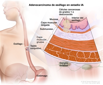 Adenocarcinoma de esófago en estadio IA. En la imagen se observan el esófago y el estómago. En una ampliación, se muestran células cancerosas en la mucosa y la capa muscular delgada de la pared del esófago. Las células cancerosas son de grado 1 o de grado desconocido. Además, se observan la submucosa, la capa muscular gruesa y el tejido conjuntivo de la pared del esófago. También se muestran ganglios linfáticos.
