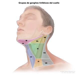 Grupos de ganglios linfáticos del cuello; el dibujo muestra seis grupos de ganglios linfáticos en el cuello: grupo IA y IB, grupo IIA y IIB, grupo III, grupo IV, grupo VA y VB, y grupo VI.