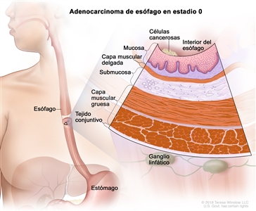 Adenocarcinoma de esófago en estadio 0. En la imagen se observan el esófago y el estómago. En una ampliación, se muestran células cancerosas en el revestimiento interno de la pared del esófago. Además, se observan la mucosa, la capa muscular delgada, la submucosa, la capa muscular gruesa y el tejido conjuntivo de la pared del esófago. También se muestran ganglios linfáticos.