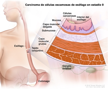 Carcinoma de células escamosas de esófago en estadio 0. En la imagen se observan el esófago y el estómago. En una ampliación, se muestran células cancerosas en el revestimiento interno de la pared del esófago. Además, se observan la mucosa, la capa muscular delgada, la submucosa, la capa muscular gruesa y el tejido conjuntivo de la pared del esófago. También se muestran ganglios linfáticos.