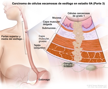 Carcinoma de células escamosas de esófago en estadio IIA (Parte 3). En la imagen se observan las partes superior y media del esófago, y el estómago. En una ampliación, se muestran células cancerosas de grado 1 en la mucosa, la capa muscular delgada, la submucosa, la capa muscular gruesa y el tejido conjuntivo de la pared de las partes superior y media del esófago. También se muestran ganglios linfáticos.