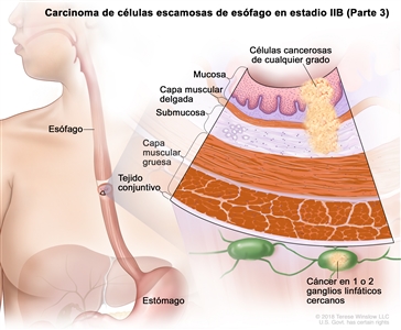 Carcinoma de células escamosas de esófago en estadio IIB (Parte 3). En la imagen se observan el esófago y el estómago. En una ampliación, se muestran células cancerosas de cualquier grado en la mucosa, la capa muscular delgada y la submucosa de la pared del esófago. También se observan la capa muscular gruesa y el tejido conjuntivo de la pared del esófago. Además, se muestra cáncer en 1 ganglio linfático cercano.