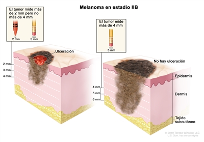 Dibujo de dos paneles del melanoma en estadio IIB. En el panel de la izquierda se observa un tumor que mide más de 2 mm pero no más 4 mm y hay ulceración (rotura de la piel). En el panel de la derecha se observa un tumor que mide más de 4 mm y no hay ulceración. También se muestran la epidermis (capa superficial o externa de la piel), la dermis (capa profunda o interna de la piel) y el tejido subcutáneo debajo de la dermis.