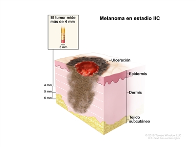 Melanoma en estadio IIC. En el dibujo se muestra un tumor que mide más de 4 mm de grosor y hay ulceración (rotura de la piel). También se observan la epidermis (capa superficial o externa de la piel), la dermis (capa profunda o interna de la piel) y el tejido subcutáneo debajo de la dermis.