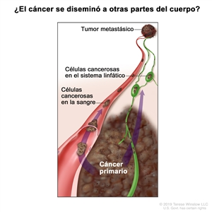 Estadificación del melanoma (el cáncer se diseminó a otras partes del cuerpo). En el dibujo se observan células cancerosas que se diseminan desde el cáncer primario, a través de la sangre y el sistema linfático, a otra parte del cuerpo donde se formó un tumor metastásico.