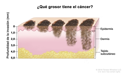 Estadificación del melanoma (grosor del tumor). En el dibujo se observan diferentes medidas de la profundidad de la invasión del cáncer (0, 1,0, 2,0, 3,0, 4,0 y 5,0 mm) dentro de la epidermis (capa superficial o externa de la piel), la dermis (capa interna de la piel) y el tejido subcutáneo debajo de la dermis.