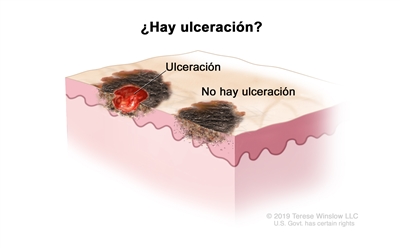 Estadificación del melanoma (ulceración del tumor). En el dibujo se observa un tumor con ulceración (rotura de la piel) y otro tumor en el que no hay ulceración.