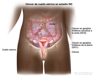 Cáncer de cuello uterino en estadio IIIC. En la imagen se observa cáncer en estadio IIIC1 que se diseminó desde el cuello uterino a los ganglios linfáticos de la pelvis, y cáncer en estadio IIIC2 que se diseminó desde el cuello uterino a los ganglios linfáticos del abdomen cercanos a la aorta.