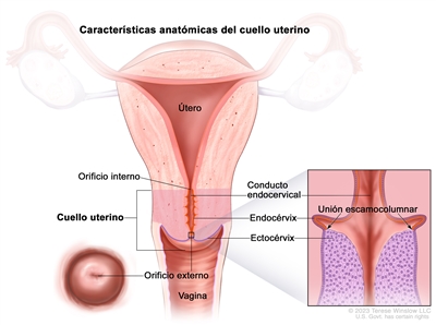 Características anatómicas del cuello uterino. En la imagen se observan el orificio interno, el conducto endocervical, el endocérvix, el ectocérvix y el orificio externo. En un recuadro se muestra la unión escamocolumnar (área donde el endocérvix se une al ectocérvix) y las células que revisten el endocérvix y el ectocérvix. También se observan el útero y la vagina.