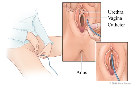 Person spreading the labia and inserting catheter into the urethra opening, above the vagina.