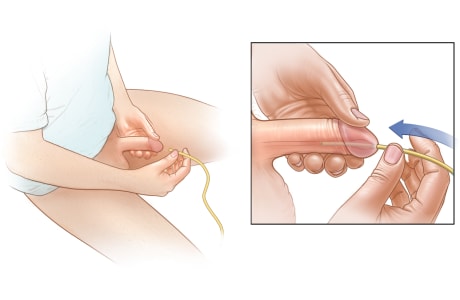 Person inserting catheter into urethra opening at end of penis.