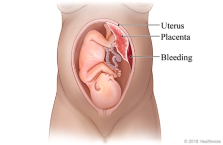 Baby in uterus, showing placenta separated from wall of uterus and bleeding.