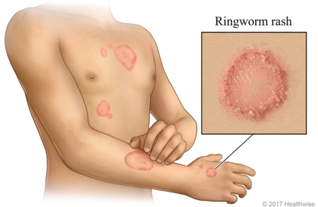 Ringworm skin rash on arm and chest, with a close-up of rash.