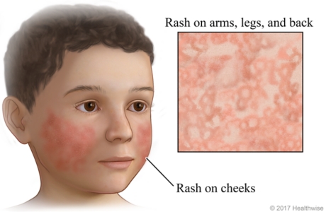 Fifth disease rash on face, with close-up of second-stage body rash.