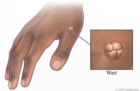 warts on hands treatment