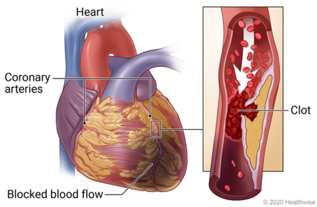Heart showing blocked coronary artery and area with blocked blood flow, with detail of blood clot in artery blocking blood flow