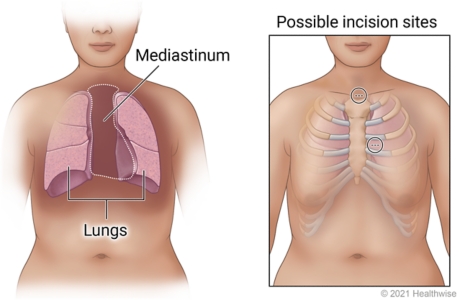 Possible incision sites above and at side of breastbone, with inside view of mediastinum space between lungs.